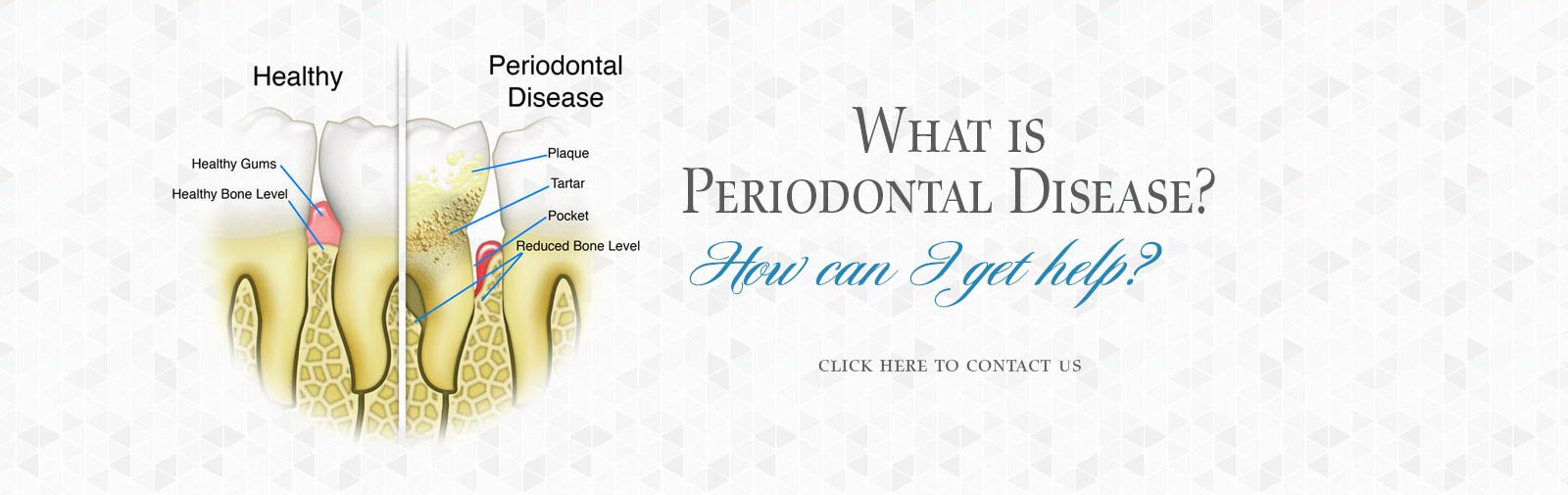 Periodontal Disease