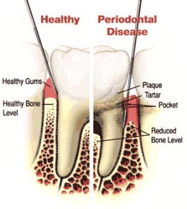 gum-disease